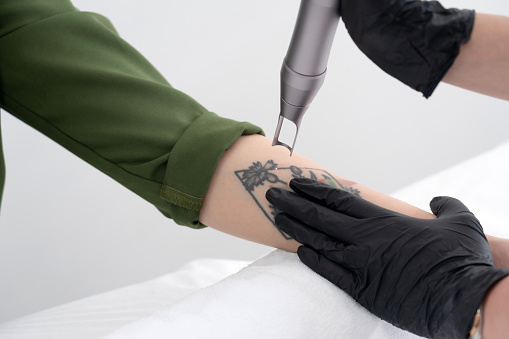 tetoválás eltávolítás